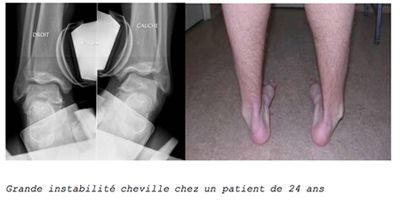 cheville 2.jpg
