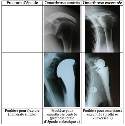 fracture épaule 1.jpg