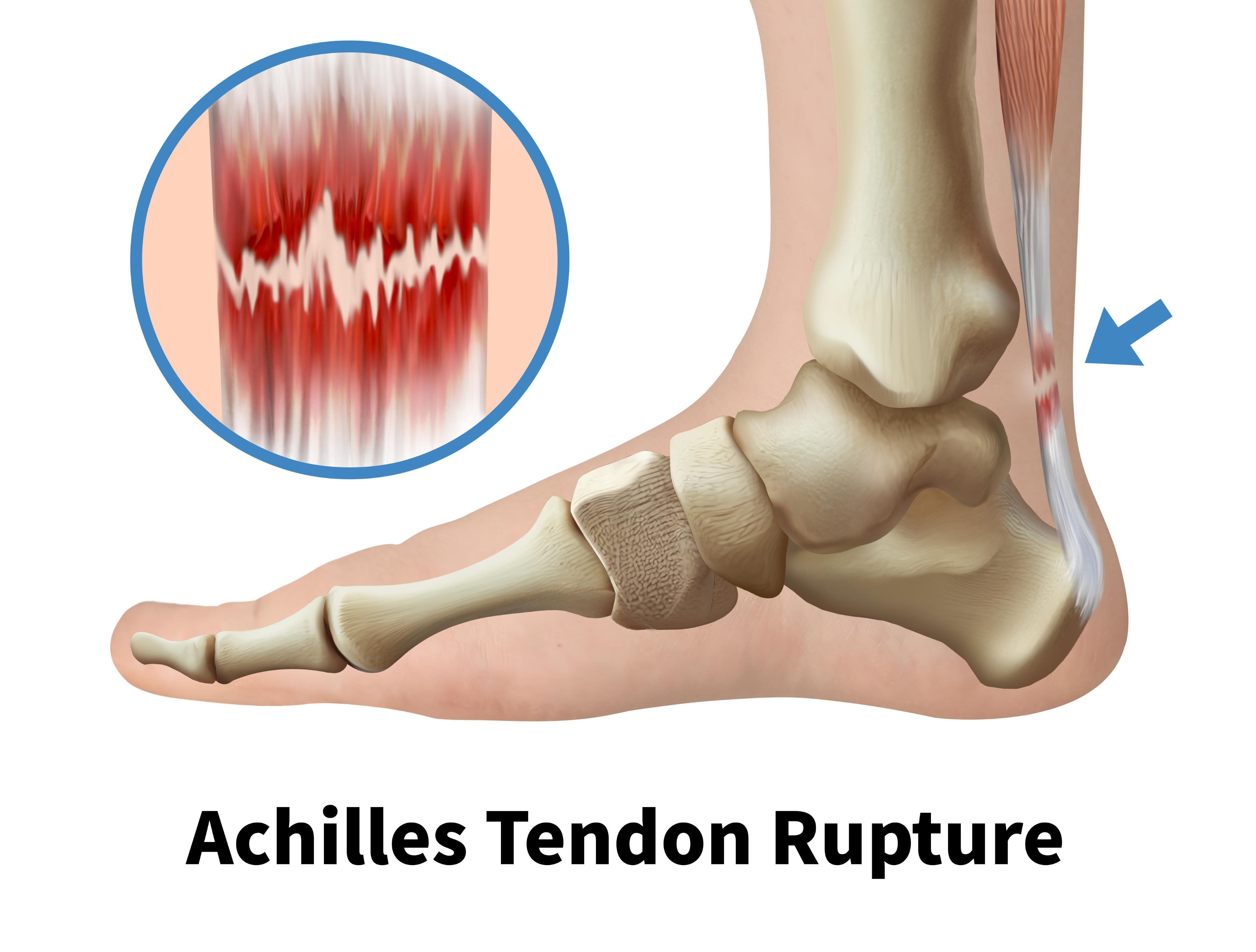 rupture tendon achille 2.jpg